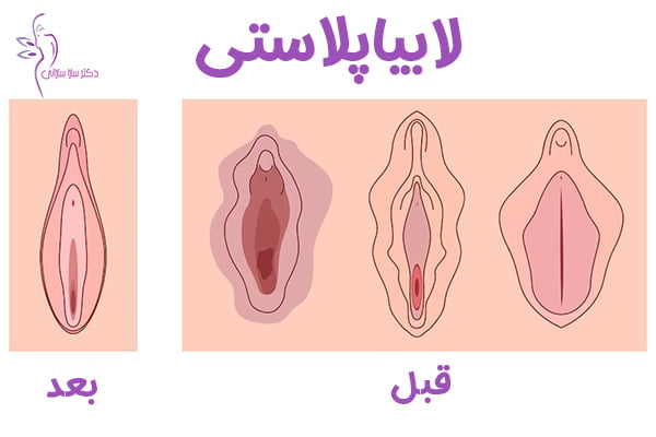 لابیاپلاستی - دکتر سارا سارانی