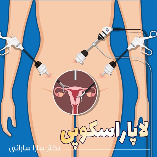 لاپاراسکوپی - دکتر سارا سارانی