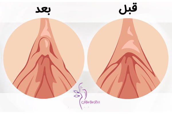 عکس قبل و بعد هودکتومی