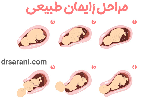 عکس مراحل زایمان طبیعی