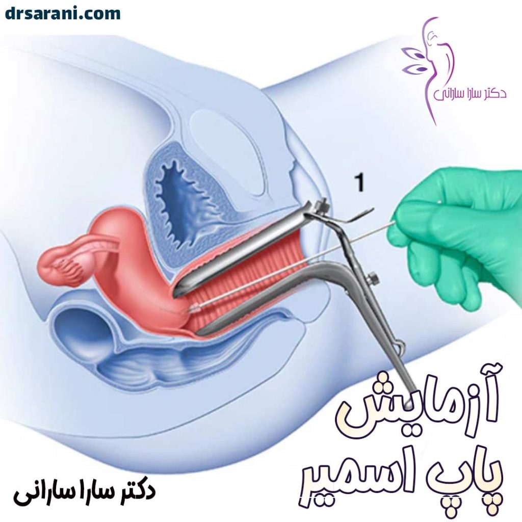 آزمایش پاپ اسمیر - دکتر سارا سارانی - https://drsarani.com/